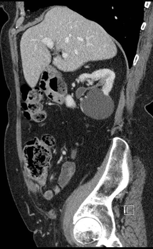 Calcified adrenal glands and Spigelian hernia (Radiopaedia 49741-54988 C 114).jpg