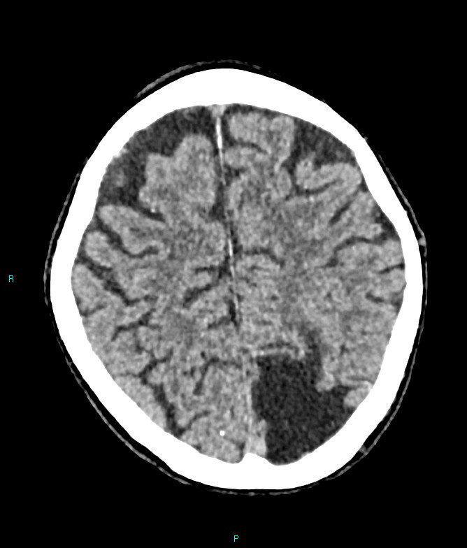 Calcified cerebral emboli from left ventricular thrombus (Radiopaedia 84420-99758 Axial non-contrast 27).jpg
