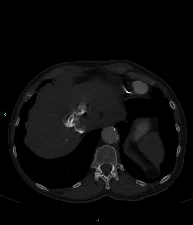 Calcified cerebral emboli from left ventricular thrombus (Radiopaedia 84420-99760 Axial bone window 73).jpg