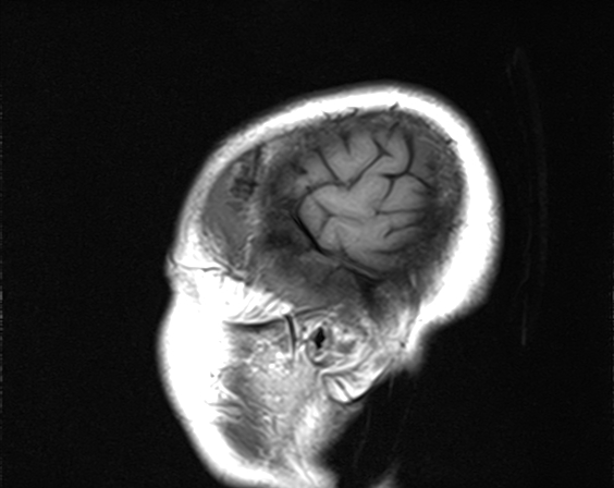 File:Calcified cerebral hydatid cyst (Radiopaedia 65603-74699 Sagittal T1 1).jpg