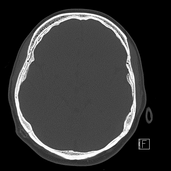 Calcified chronic subdural hematoma (Radiopaedia 77374-89492 Axial bone window 52).jpg