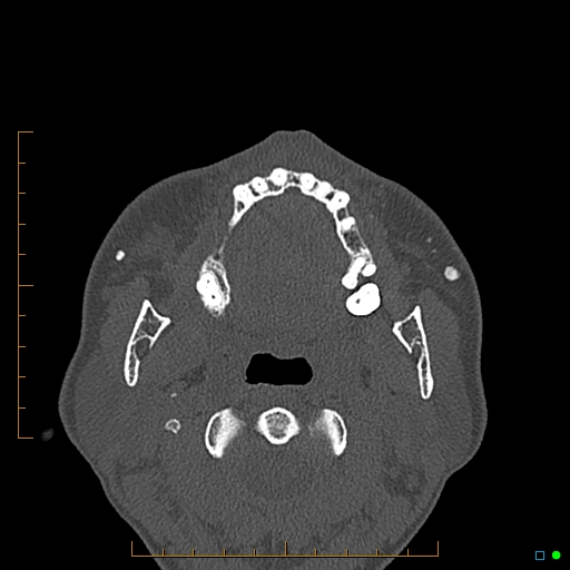 Calcified facial augmentation fillers (Radiopaedia 79514-92679 Axial bone window 84).jpg