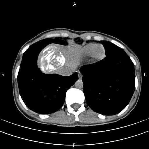 File:Calcified hepatic hydatid cyst (Radiopaedia 83870-99072 Axial non-contrast 13).jpg