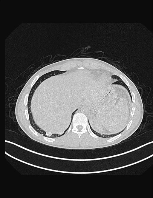 Calcifying pulmonary metastases (Radiopaedia 33359-34396 Axial lung window 54).jpg