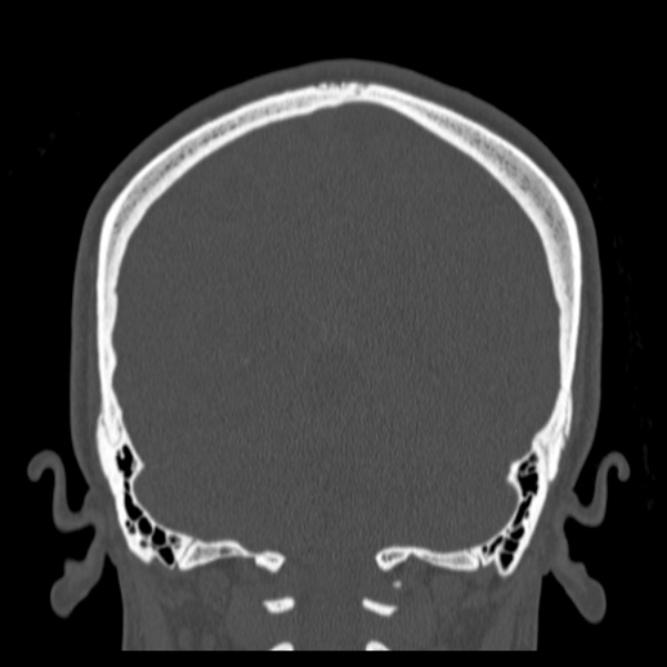 Calvarial osteoma (Radiopaedia 36520-38079 C 66).jpg