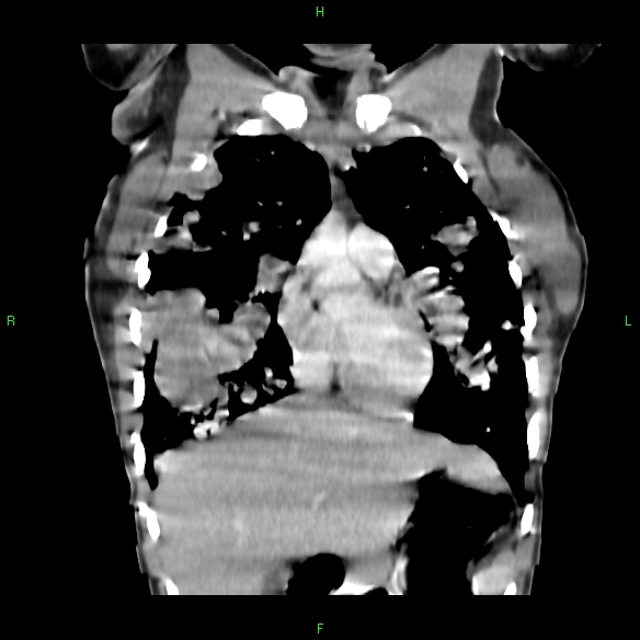 File:Cannon ball metastases - synovial sarcoma (Radiopaedia 26135-26271 Coronal liver window 4).jpg