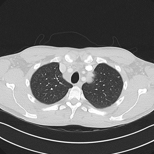 Cannonball metastases - testicular choriocarcinoma (Radiopaedia 84510-99891 Axial lung window 23).jpg