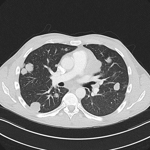 File:Cannonball metastases - testicular choriocarcinoma (Radiopaedia 84510-99891 Axial lung window 48).jpg