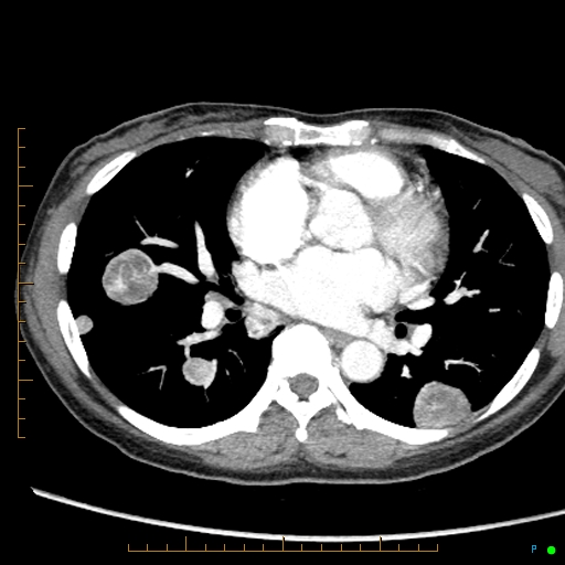 Canonball lung metastasis (Radiopaedia 77634-89837 B 54).jpg