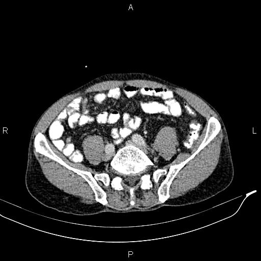 Caput medusae sign - portal hypertension (Radiopaedia 64007-72759 A 69).jpg