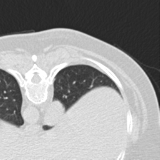 File:Carcinoid tumor - lung (Radiopaedia 44814-48644 Axial lung window 14).png
