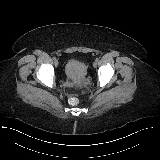 Carcinoid tumor - terminal ileum (Radiopaedia 60931-68740 Axial non-contrast 112).jpg