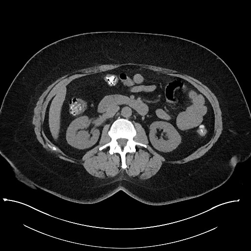 Carcinoid tumor - terminal ileum (Radiopaedia 60931-68740 Axial non-contrast 48).jpg