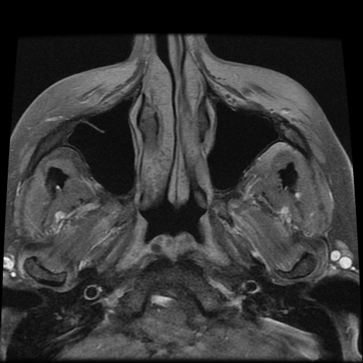 File:Carcinoid tumor of the ileum with metastasis to orbit (Radiopaedia 28165-28424 Axial T1 C+ fat sat 1).jpg