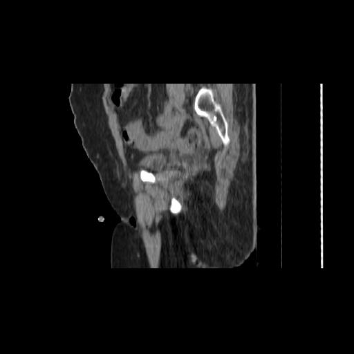 File:Carcinoma cervix- brachytherapy applicator (Radiopaedia 33135-34173 D 53).jpg