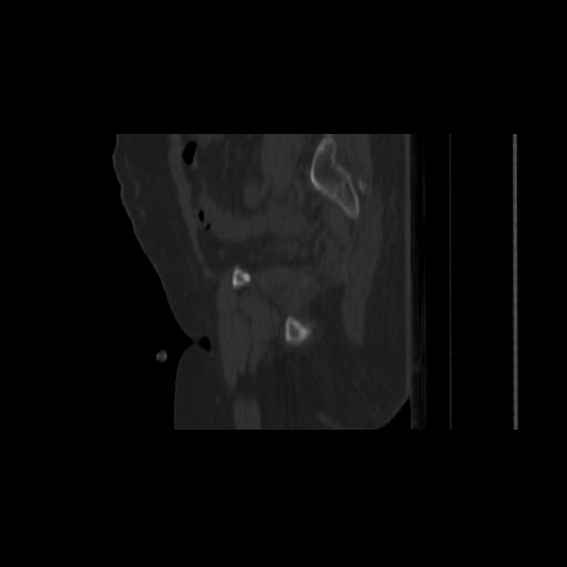 Carcinoma cervix- brachytherapy applicator (Radiopaedia 33135-34173 Sagittal bone window 46).jpg