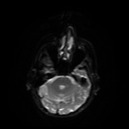 Carcinoma ex-pleomorphic adenoma of parotid (Radiopaedia 28383-28627 Ax DWI B-500 GE 27).jpg