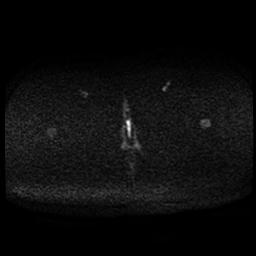 Carcinoma of the cervix (Radiopaedia 89018-105858 Axial DWI 42).jpg