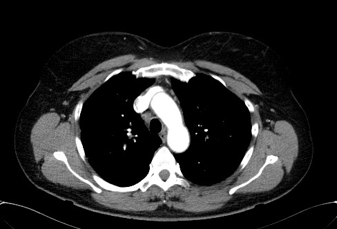 Cardiac sarcoidosis (Radiopaedia 74548-85534 A 24).jpg