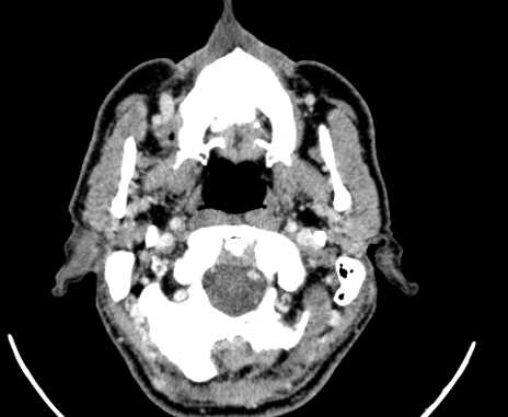 Carotid body tumor (Radiopaedia 61750-69757 Axial Post contrast 5).jpg