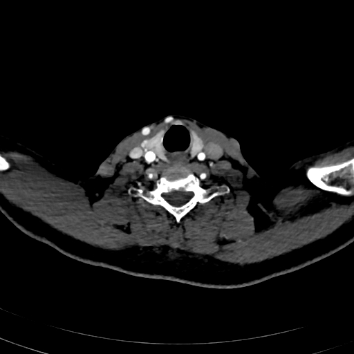 File:Carotid body tumor (Radiopaedia 83615-98727 A 90).jpg