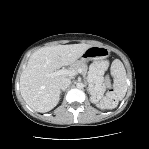 Castleman disease with fibrous pseudotumor in the abdomen (Radiopaedia 77296-89373 A 35).jpg