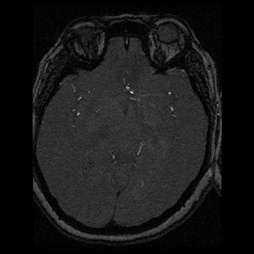 Cavernoma, DVA and right ICA aneurysm (Radiopaedia 33890-35072 E 40).png