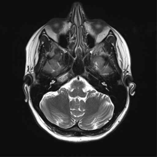 File:Cavernoma with bleed - midbrain (Radiopaedia 54546-60773 Axial T2 9).png