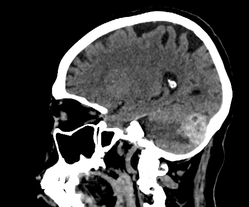 Cavernous hemangioma of the cerebellar falx (Radiopaedia 73025-83723 B 119).jpg