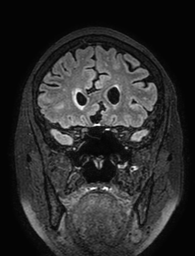 Cavernous hemangioma of the cerebellar falx (Radiopaedia 73025-83724 Coronal FLAIR 98).jpg