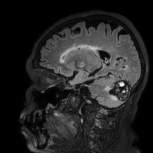 Cavernous hemangioma of the cerebellar falx (Radiopaedia 73025-83724 Sagittal FLAIR 140).jpg