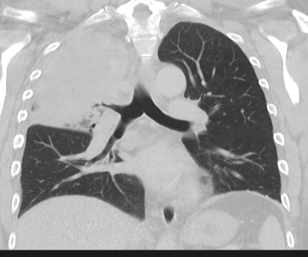 File:Cavitating pneumonia (Radiopaedia 45998-50329 Coronal lung window 29).png