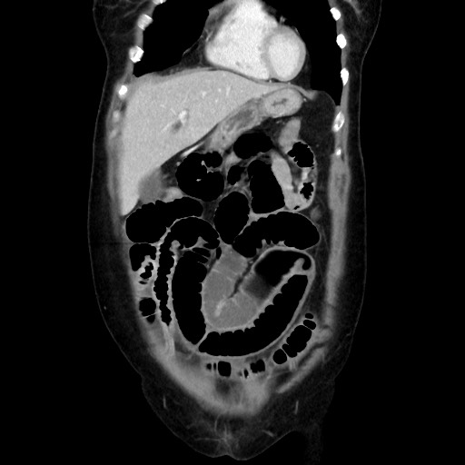 Cecal adenocarcinoma (Radiopaedia 75909-87331 B 15).jpg