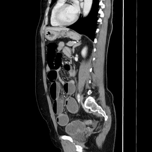 File:Cecal adenocarcinoma (Radiopaedia 75909-87331 C 45).jpg