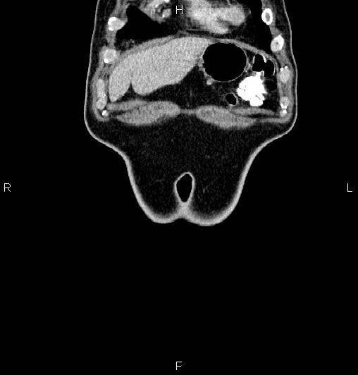 Cecal adenocarcinoma (Radiopaedia 85324-100916 D 3).jpg