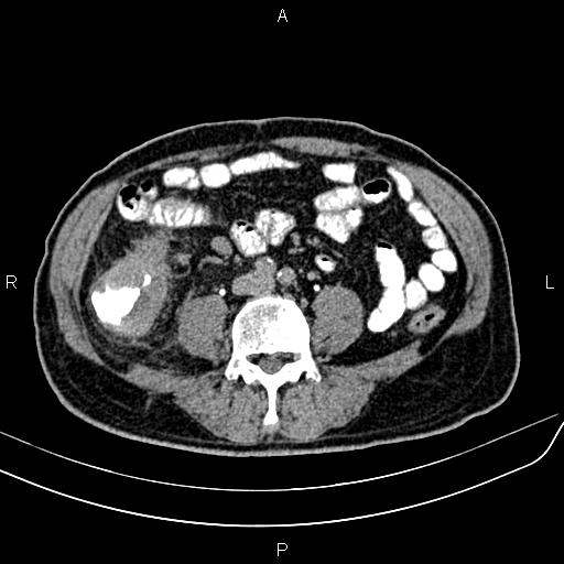 File:Cecal cancer with appendiceal mucocele (Radiopaedia 91080-108651 Axial C+ delayed 44).jpg