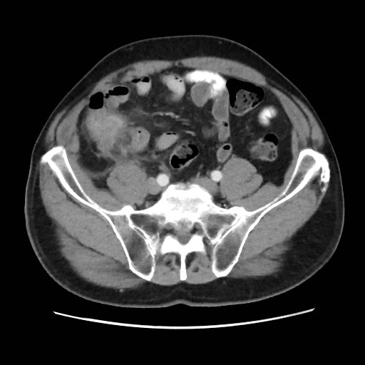 Cecal mass causing appendicitis (Radiopaedia 59207-66531 A 64).jpg