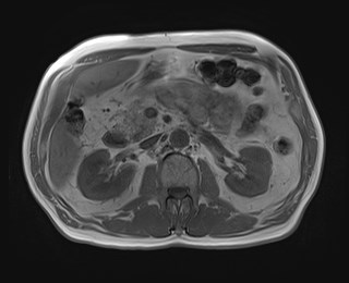 Cecal mass causing appendicitis (Radiopaedia 59207-66532 Axial T1 in-phase 56).jpg