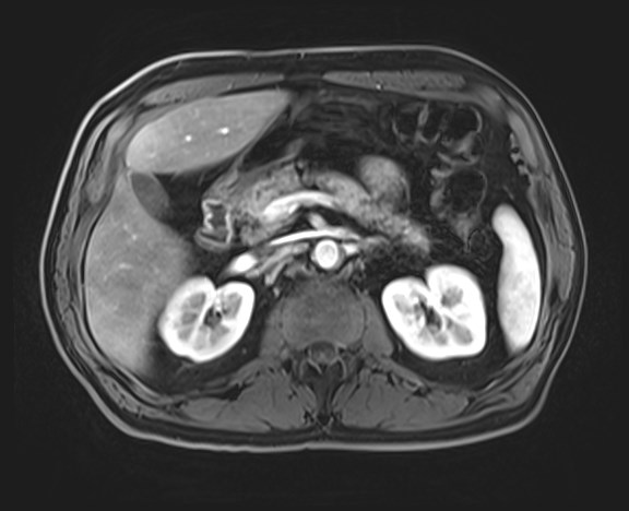 Cecal mass causing appendicitis (Radiopaedia 59207-66532 H 52).jpg