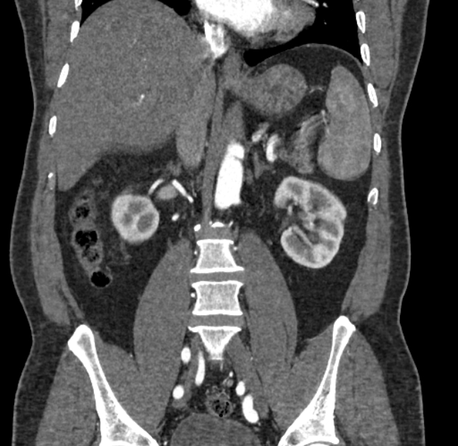 Celiac artery dissection (Radiopaedia 52194-58080 C 76).jpg