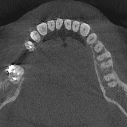 Cemento-osseous dysplasia (Radiopaedia 48251-53126 Axial non-contrast 50).jpg