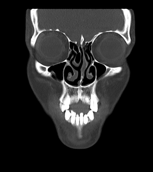 Cemento-ossifying fibroma (Radiopaedia 46243-50643 Coronal bone window 16).png