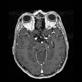 File:Central-variant posterior reversible encephalopathy syndrome (PRES) (Radiopaedia 43880-47358 Axial T1 C+ 60).jpg