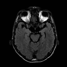 File:Central-variant posterior reversible encephalopathy syndrome (PRES) (Radiopaedia 43880-47359 Axial FLAIR 8).jpg