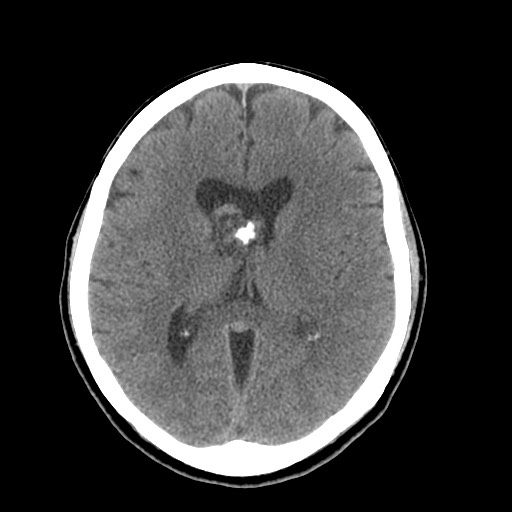 Central neurocytoma (Radiopaedia 68725-78432 Axial non-contrast 28).jpg