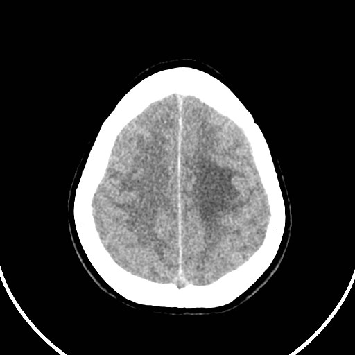 Central neurocytoma (Radiopaedia 84497-99871 Axial non-contrast 43).jpg