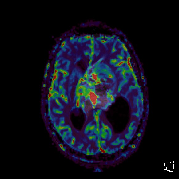 Central neurocytoma (Radiopaedia 84497-99872 Axial Perfusion 150).jpg