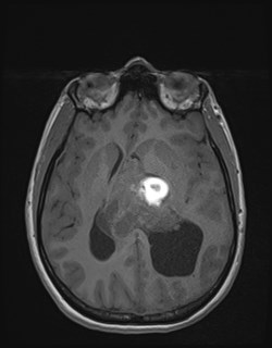 Central neurocytoma (Radiopaedia 84497-99872 Axial T1 109).jpg