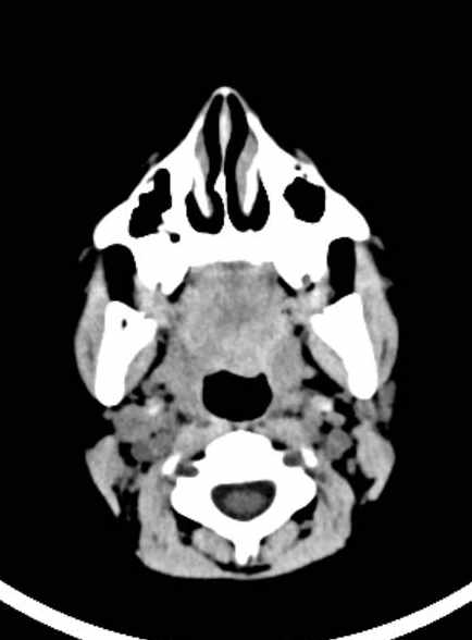Cerebellar abscess (Radiopaedia 73727-84527 Axial non-contrast 10).jpg