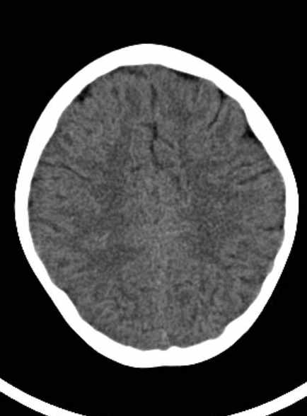 Cerebellar abscess (Radiopaedia 73727-84527 Axial non-contrast 49).jpg